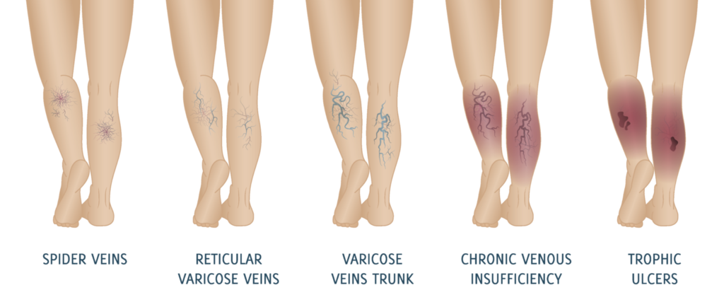 Types of Varicose Veins