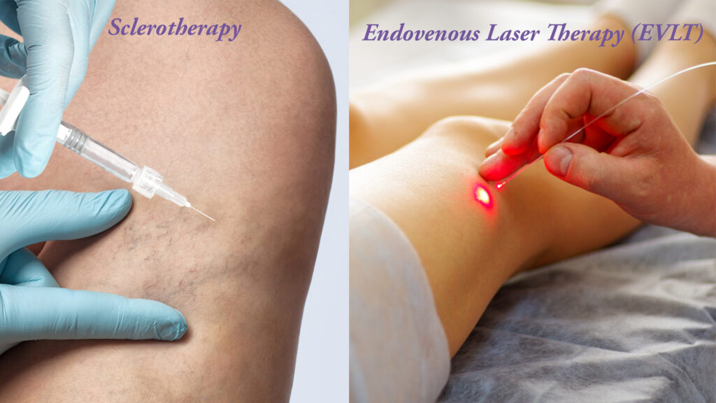 image showing both a sclerotherapy procedure and an EVLT procedure side-by-side, highlighting the differences in techniques and equipment.