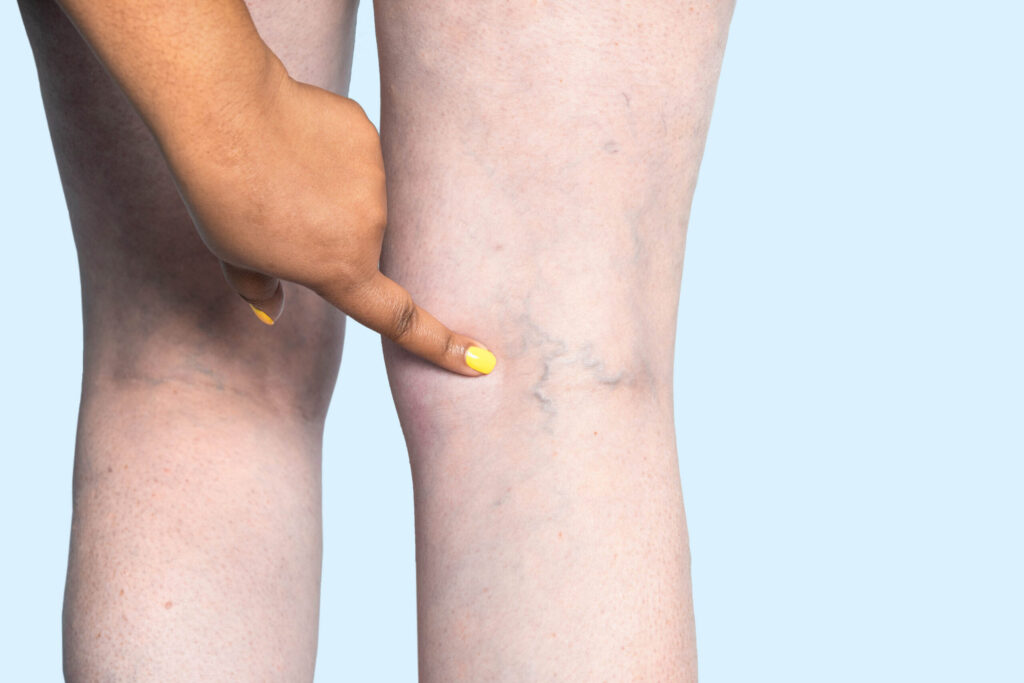 A high-definition image of a leg with visible varicose veins, illustrating the physical symptoms of chronic venous insufficiency.