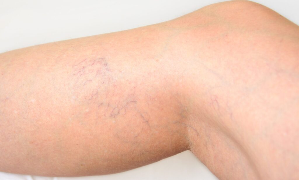 A close-up of spider veins on a person's leg, illustrating common vein health concerns.