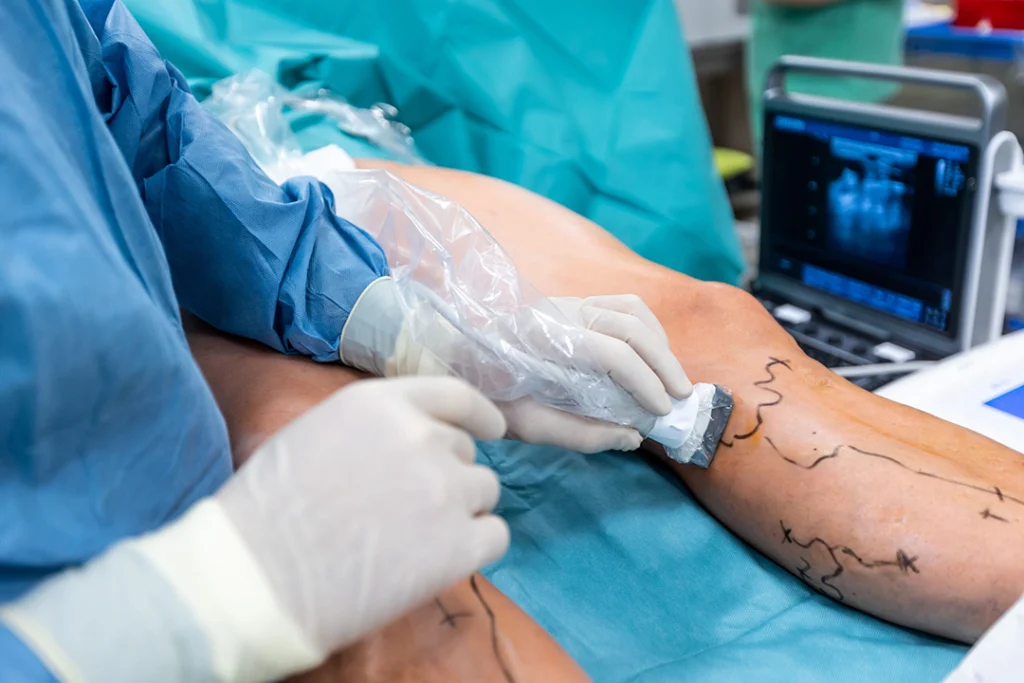 A physician doing ultrasound of varicose veins